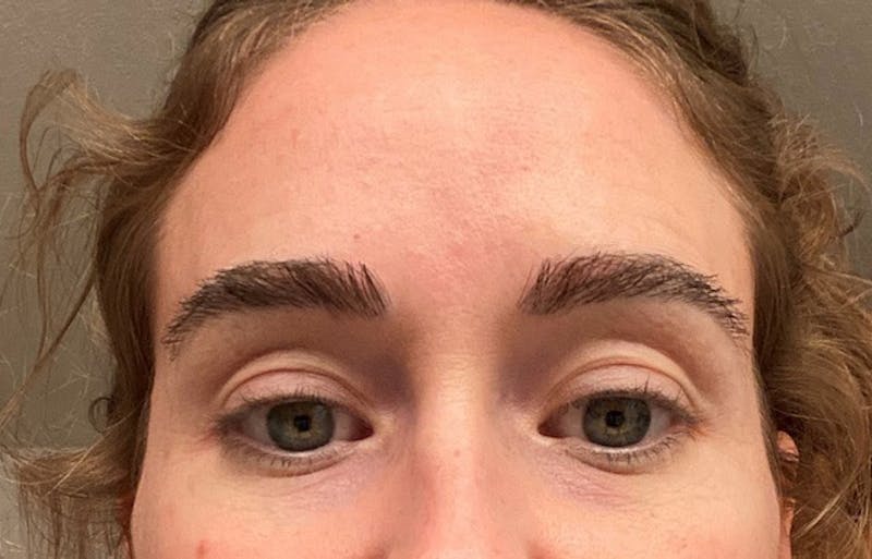 Eyebrow Transplantation Before & After Gallery - Patient 302638 - Image 2