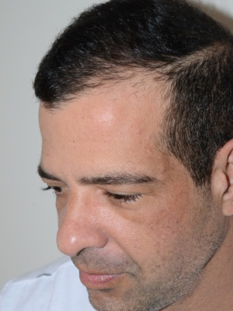 Hair Transplant Repair Before & After Gallery - Patient 144279 - Image 6