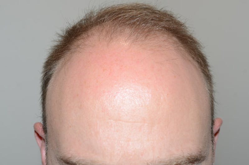 Hair Restoration for Men Before & After Gallery - Patient 256871 - Image 1