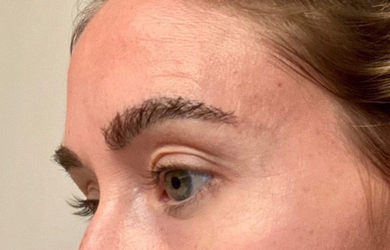 Eyebrow Transplantation Before & After Gallery - Patient 302638 - Image 4