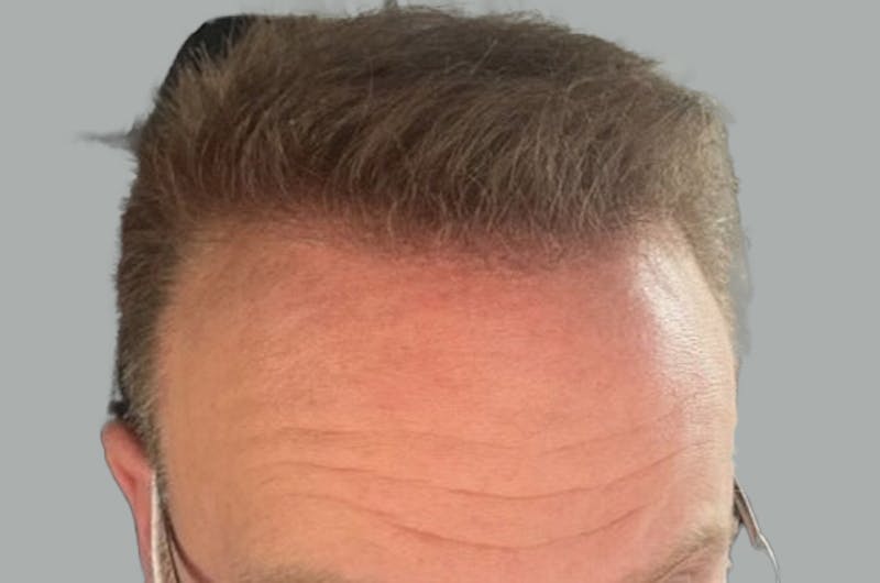 Hair Restoration for Men Before & After Gallery - Patient 256871 - Image 2