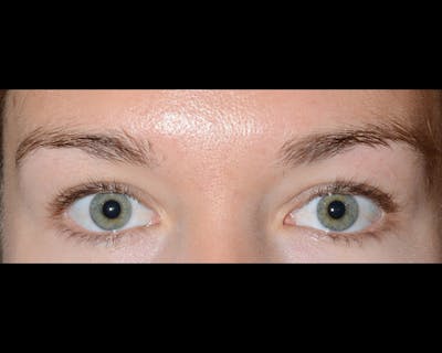 Eyebrow Transplantation Before & After Gallery - Patient 149849 - Image 1
