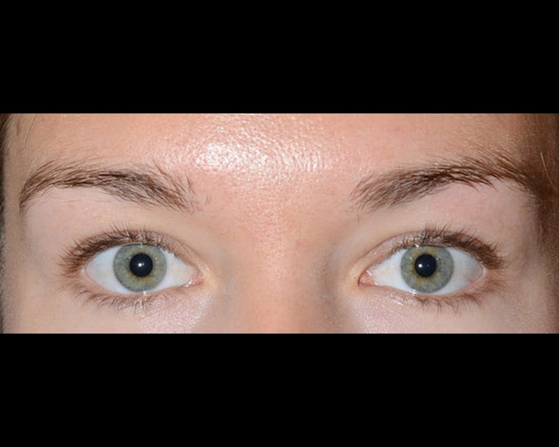 Eyebrow Transplantation Before & After Gallery - Patient 224754 - Image 1