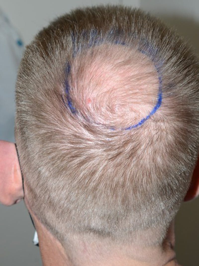 Hair Restoration for Men Before & After Gallery - Patient 315407 - Image 1
