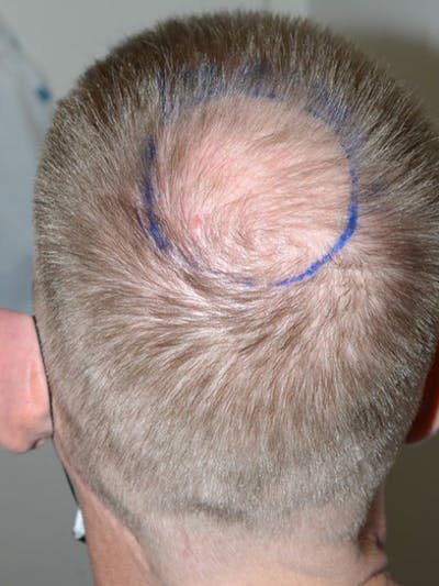 Hair Restoration for Men Before & After Gallery - Patient 322962 - Image 1