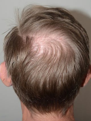 Hair Transplant Repair Before & After Gallery - Patient 393814 - Image 2