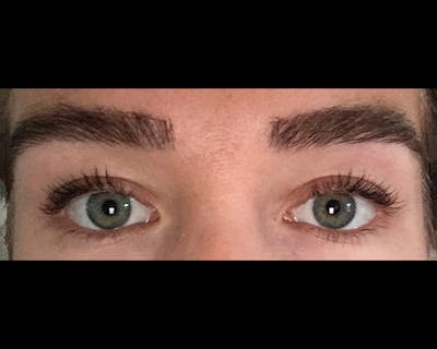 Eyebrow Transplantation Before & After Gallery - Patient 149849 - Image 2