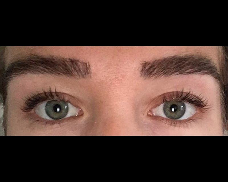 Eyebrow Transplantation Before & After Gallery - Patient 224754 - Image 2