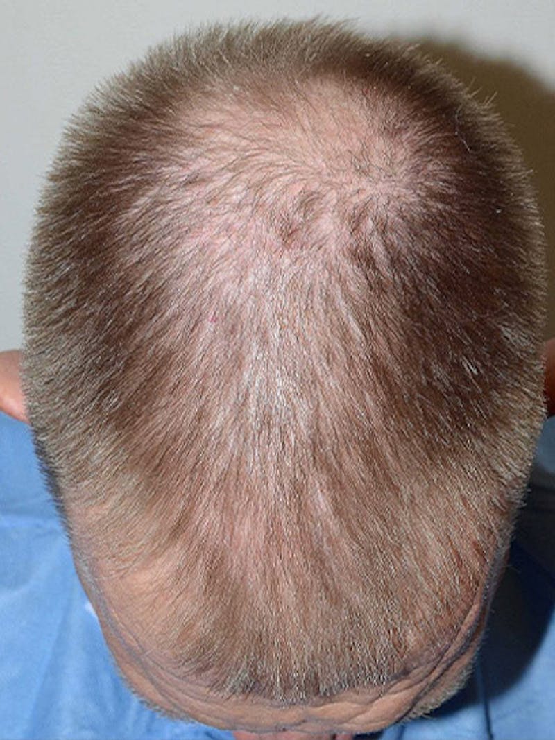 Hair Restoration for Men Before & After Gallery - Patient 315407 - Image 3
