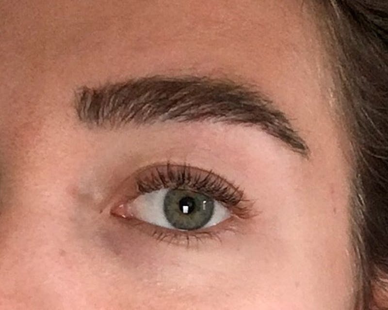 Eyebrow Transplantation Before & After Gallery - Patient 224754 - Image 4