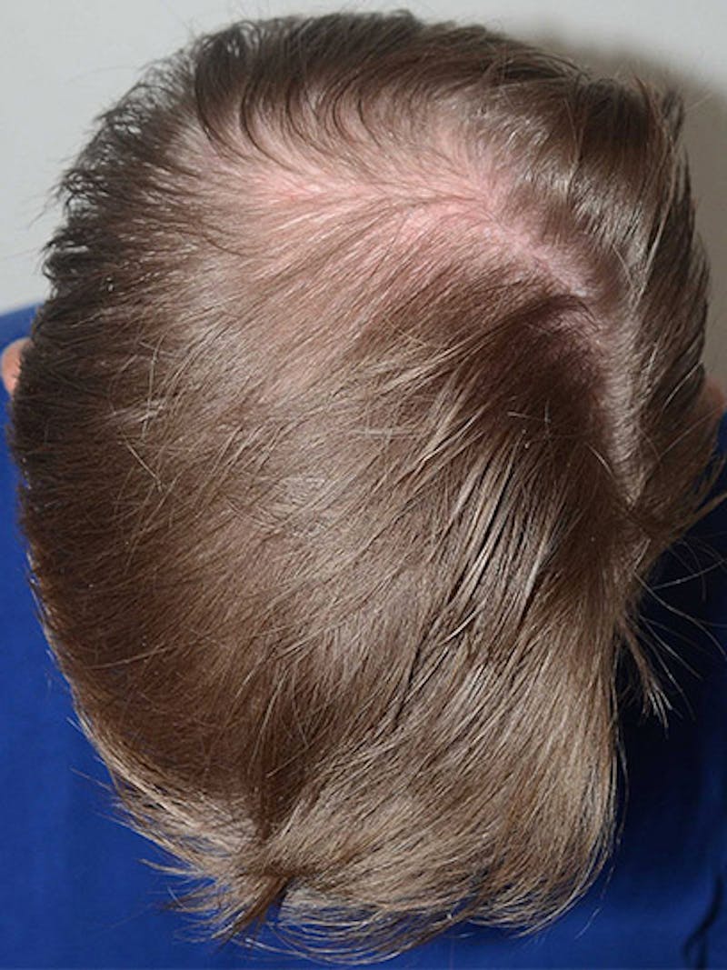 Hair Restoration for Men Before & After Gallery - Patient 315407 - Image 4