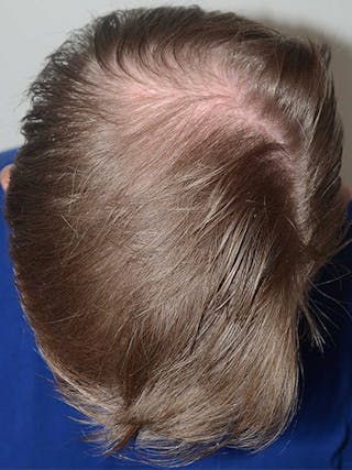 Hair Transplant Repair Before & After Gallery - Patient 393814 - Image 4