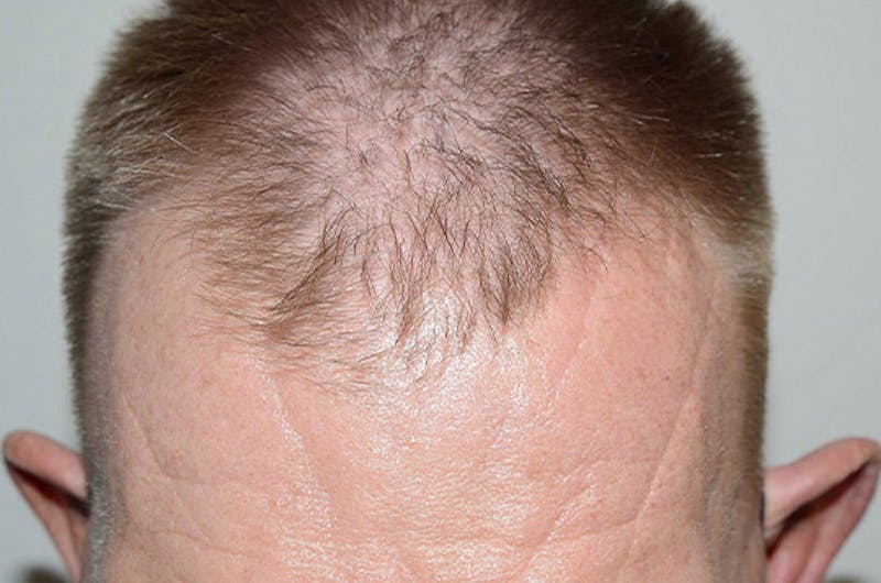 Hair Restoration for Men Before & After Gallery - Patient 315407 - Image 5