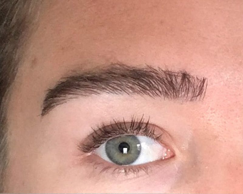 Eyebrow Transplantation Before & After Gallery - Patient 224754 - Image 6
