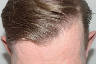 Hair Transplant Repair Before & After Gallery - Patient 393814 - Image 6