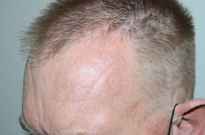 Hair Restoration for Men Before & After Gallery - Patient 315407 - Image 7