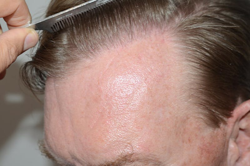 Hair Restoration for Men Before & After Gallery - Patient 315407 - Image 8