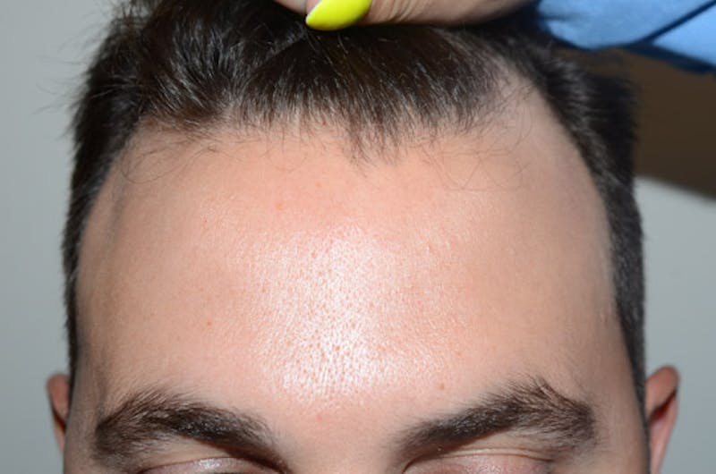 Hair Restoration for Men Before & After Gallery - Patient 205933 - Image 1