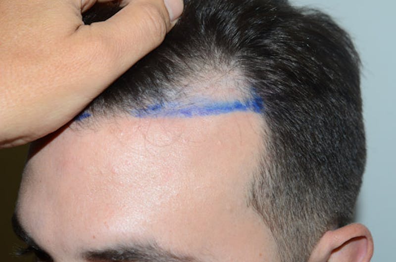 Hair Restoration for Men Before & After Gallery - Patient 205933 - Image 3