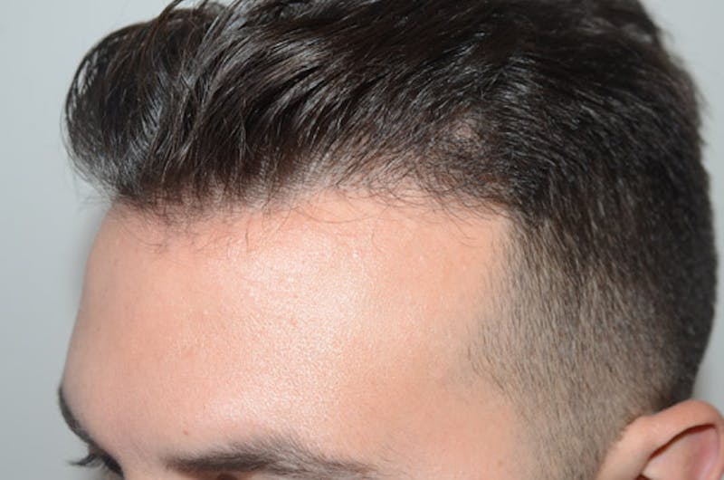 Hair Restoration for Men Before & After Gallery - Patient 205933 - Image 4