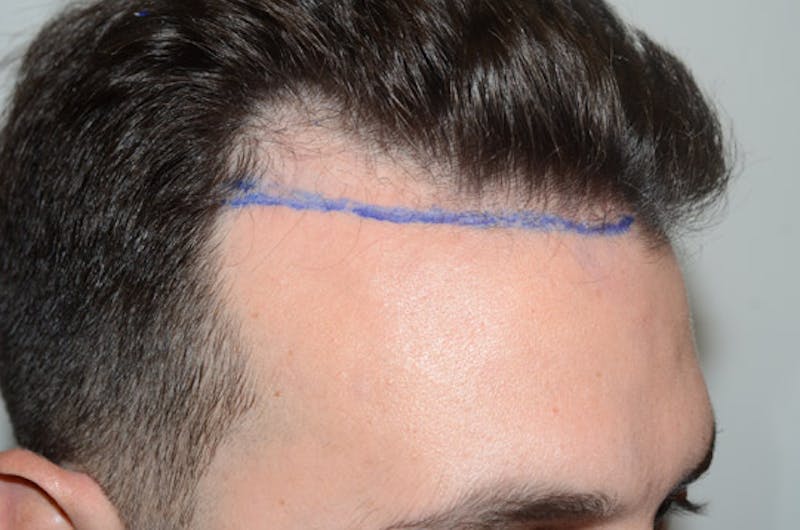 Hair Restoration for Men Before & After Gallery - Patient 205933 - Image 5
