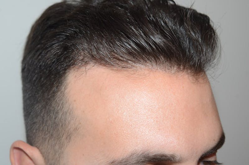 Hair Restoration for Men Before & After Gallery - Patient 205933 - Image 6