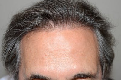 Hair Restoration for Men Before & After Gallery - Patient 316097 - Image 2