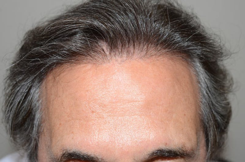 Hair Restoration for Men Before & After Gallery - Patient 633185 - Image 2