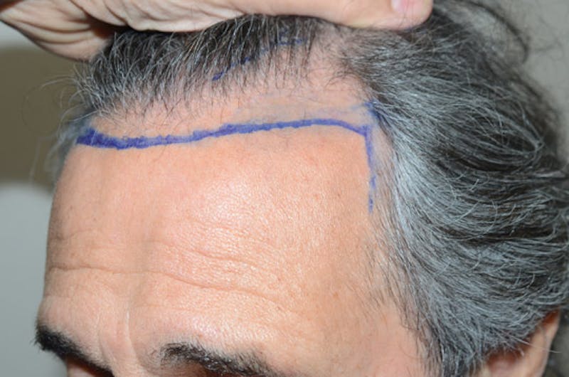 Hair Restoration for Men Before & After Gallery - Patient 633185 - Image 3