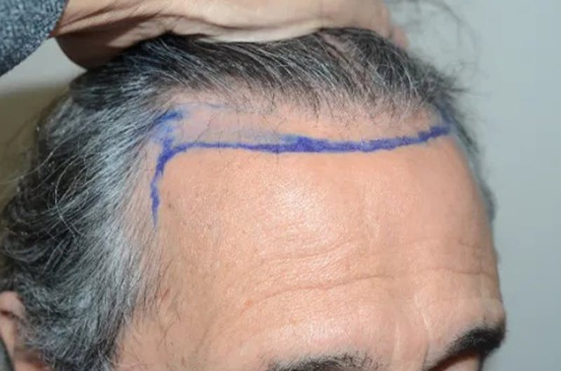 Hair Restoration for Men Before & After Gallery - Patient 633185 - Image 5