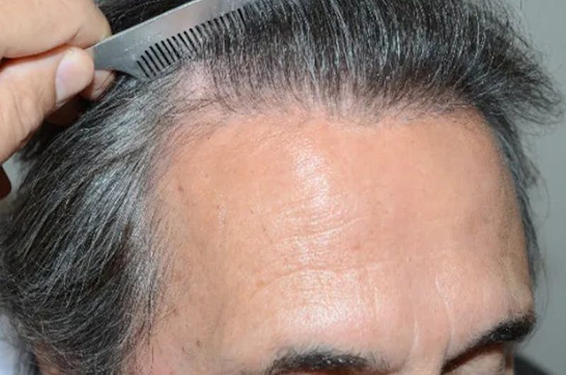Hair Restoration for Men Before & After Gallery - Patient 633185 - Image 6