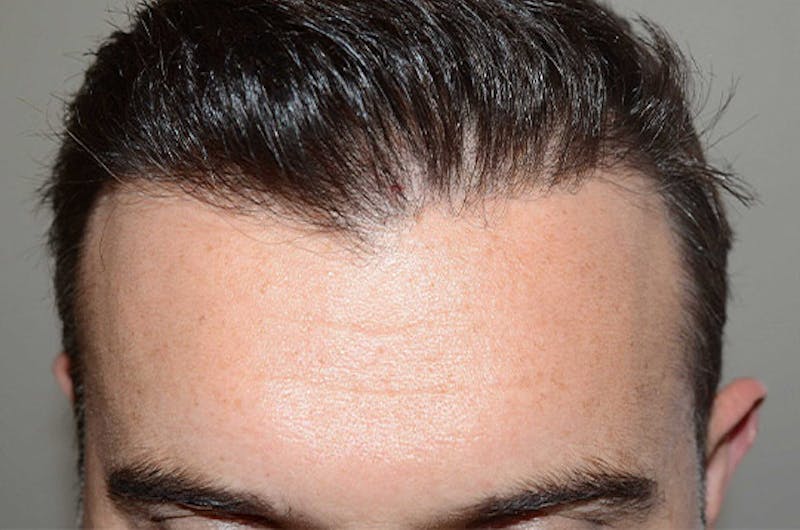 Hair Restoration for Men Before & After Gallery - Patient 110654 - Image 2