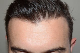 Hair Transplant Repair Before & After Gallery - Patient 802221 - Image 2