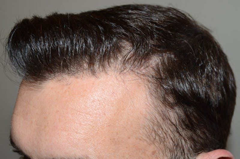 Hair Restoration for Men Before & After Gallery - Patient 110654 - Image 4
