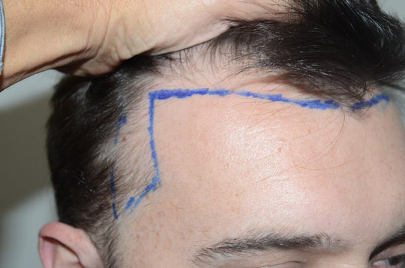 Hair Restoration for Men Before & After Gallery - Patient 110654 - Image 5