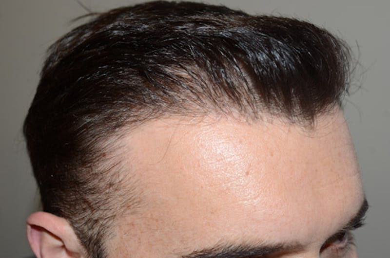Hair Restoration for Men Before & After Gallery - Patient 110654 - Image 6