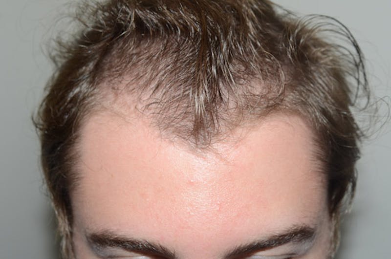 Hair Restoration for Men Before & After Gallery - Patient 300347 - Image 1