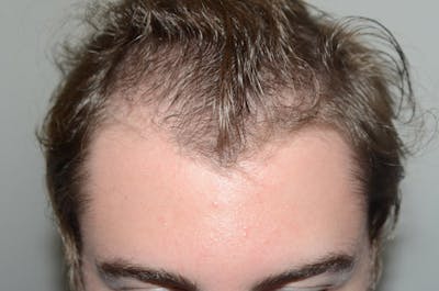 Hair Restoration for Men Before & After Gallery - Patient 187432 - Image 1