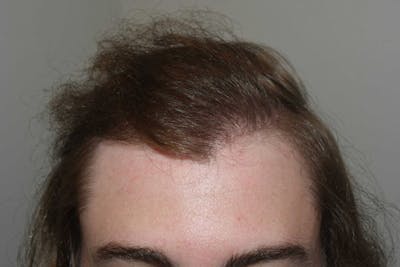 Hair Restoration for Men Before & After Gallery - Patient 187432 - Image 2