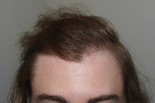 Hair Restoration for Men Before & After Gallery - Patient 187432 - Image 2