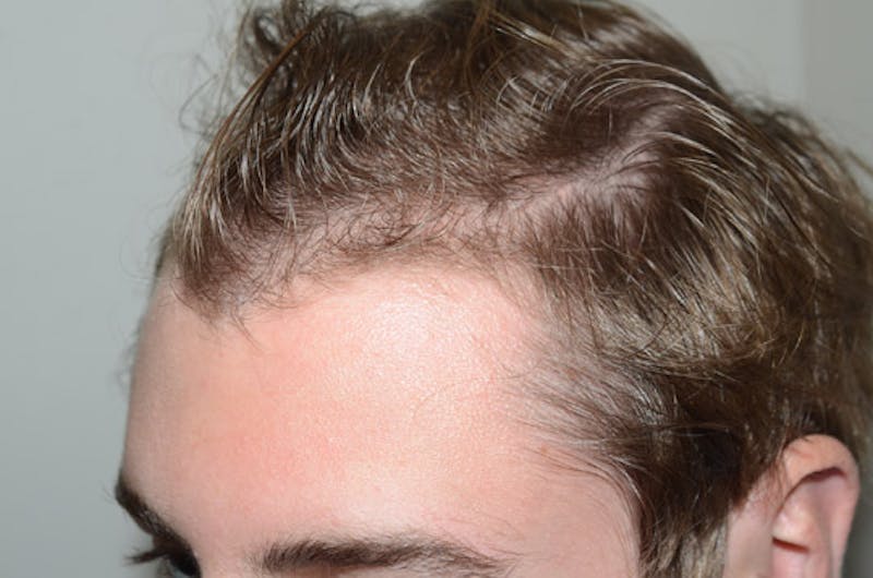 Hair Restoration for Men Before & After Gallery - Patient 300347 - Image 3