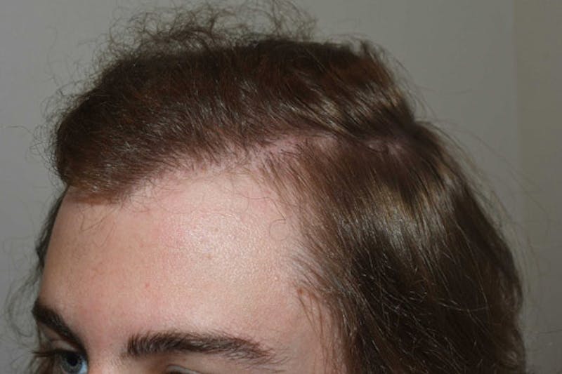 Hair Restoration for Men Before & After Gallery - Patient 300347 - Image 4