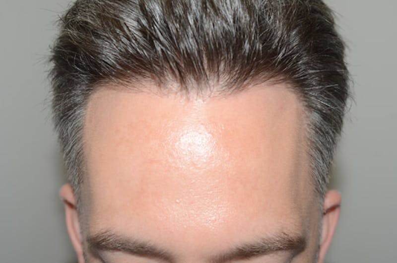 Hair Restoration for Men Before & After Gallery - Patient 340879 - Image 1