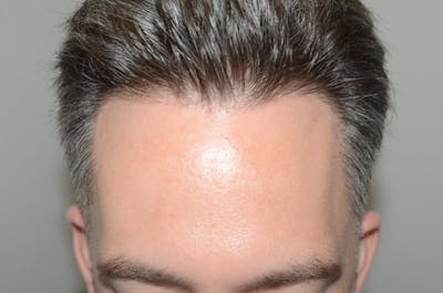 Hair Restoration for Men Before & After Gallery - Patient 192687 - Image 1