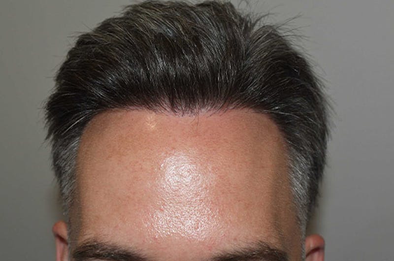 Hair Restoration for Men Before & After Gallery - Patient 340879 - Image 2