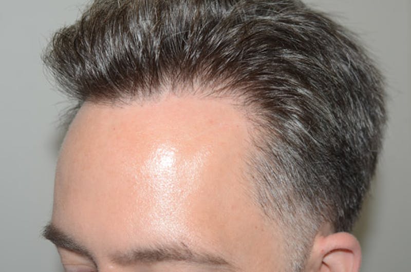 Hair Restoration for Men Before & After Gallery - Patient 340879 - Image 3