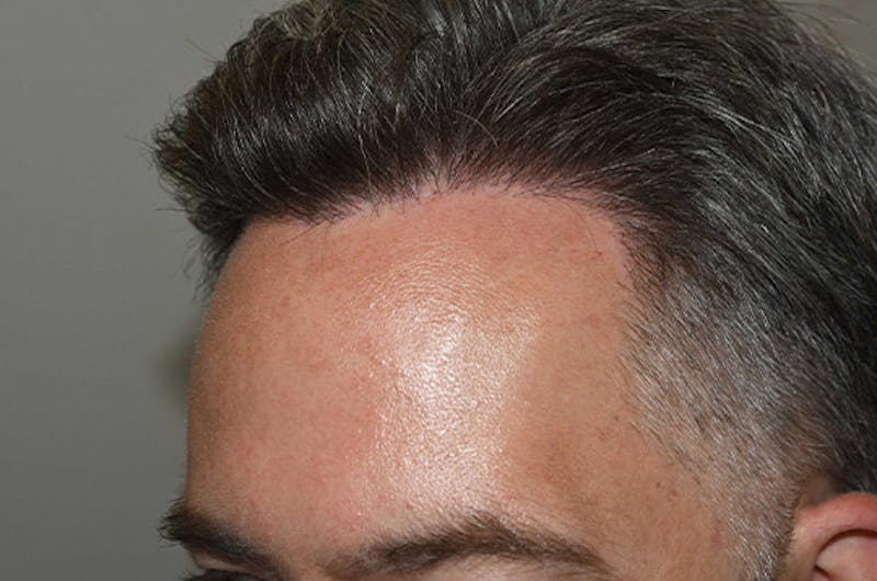Hair Restoration for Men Before & After Gallery - Patient 340879 - Image 4