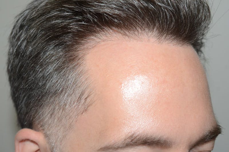 Hair Restoration for Men Before & After Gallery - Patient 340879 - Image 5