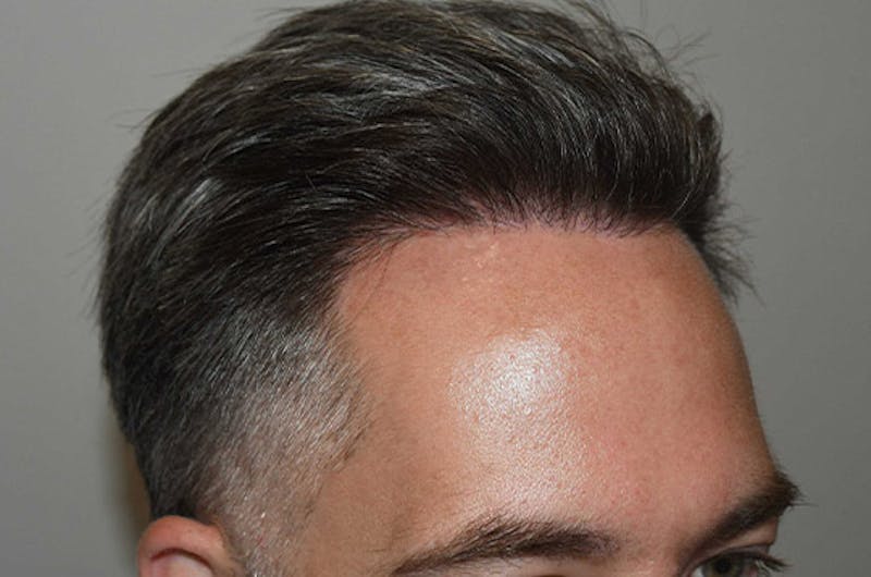Hair Restoration for Men Before & After Gallery - Patient 340879 - Image 6