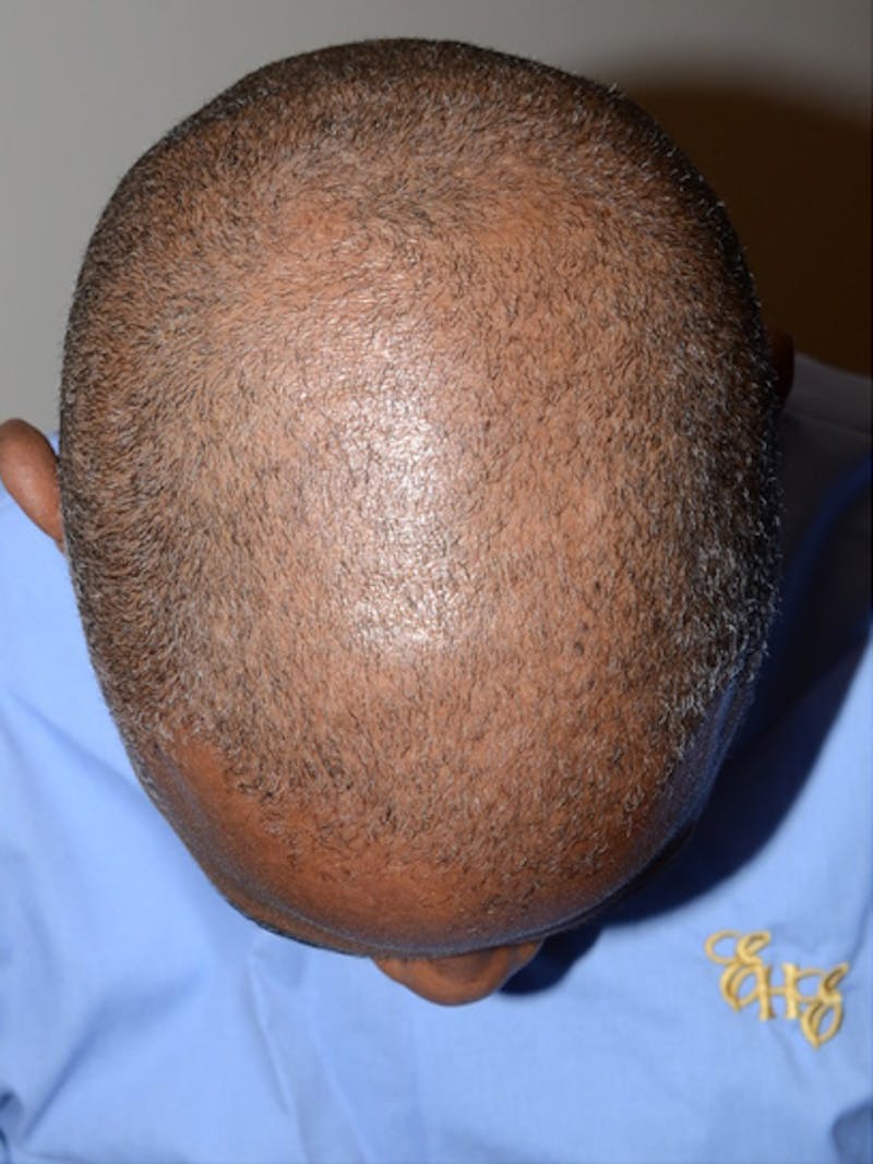 Hair Restoration for Men Before & After Gallery - Patient 790477 - Image 1